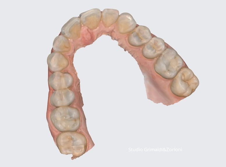 Immagine digitale acquisita con scanner intraorale