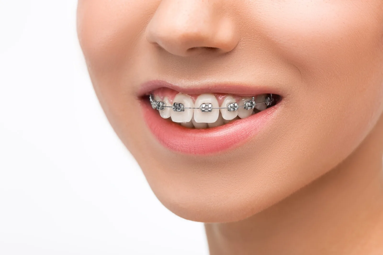 Trattamento di ortodonzia con apparecchio dentale