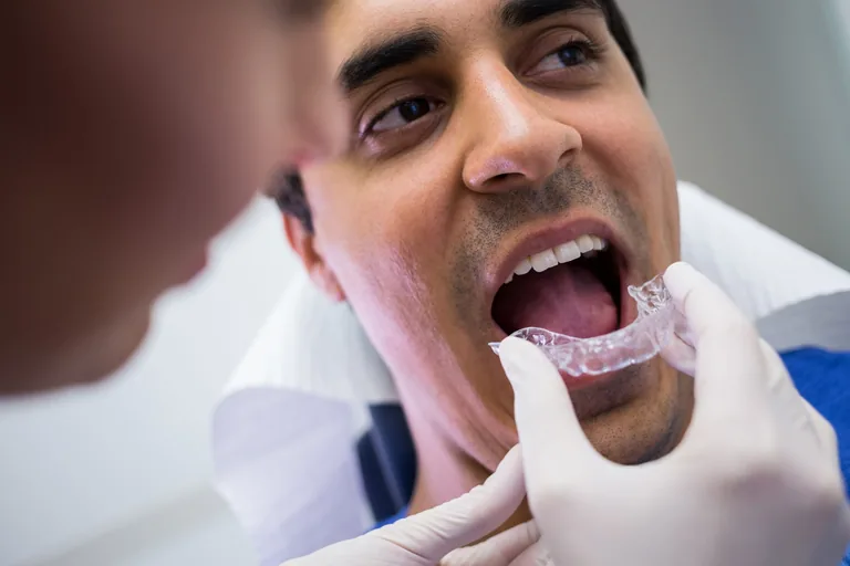 Applicazione di un allineatore ortodontico trasparente