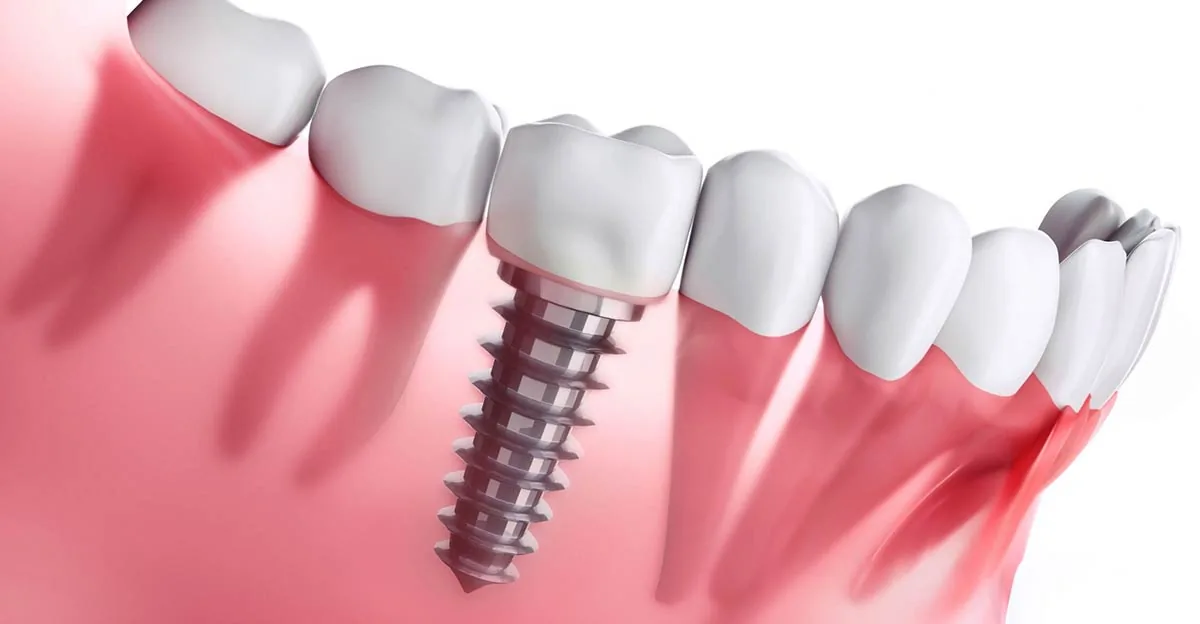 Rappresentazione di un impianto dentale